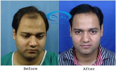 Best hair transplant in Delhi NCR