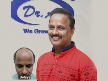 hair transplant in Delhi NCR