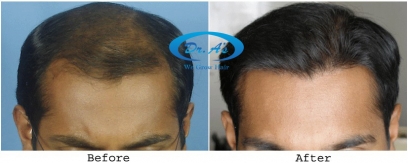 Scalp Hair Transplants (FUHT)