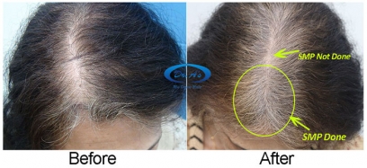 hair regrowth treatment in delhi