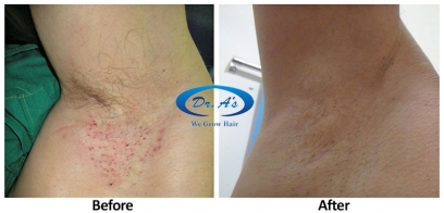 Unwanted Hair Removal