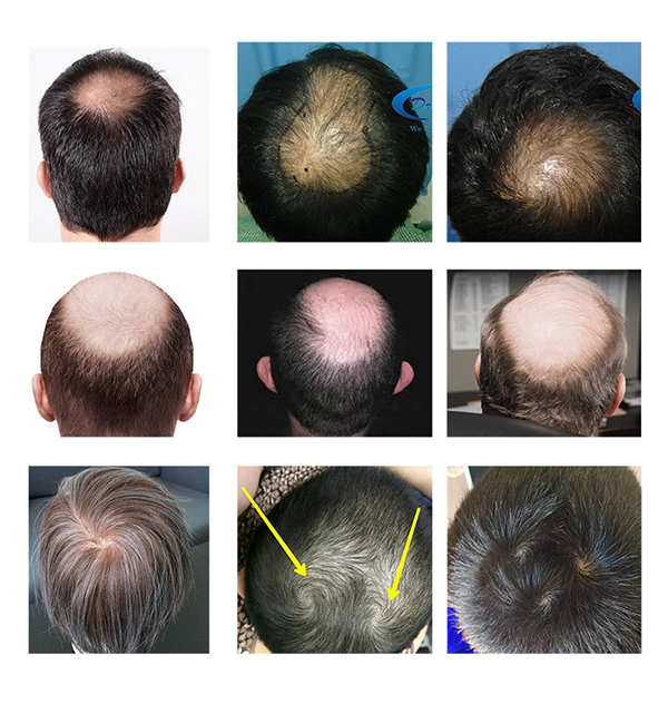 Not all CROWN are the same | Hair loss Forum - Hair Transplant forums