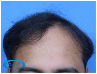 A beautiful hair transplant vandalized (picture 1)