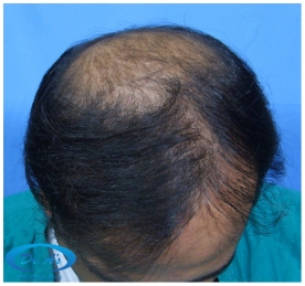 A beautiful hair transplant vandalized (picture 2)