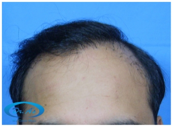 A beautiful hair transplant vandalized (picture 3)