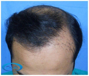 A beautiful hair transplant vandalized (picture 4)
