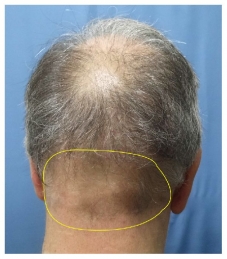 Depleted scalp donor area