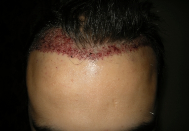 Graft placement picture 1