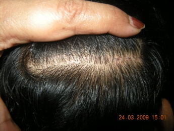 Scalp donor picture