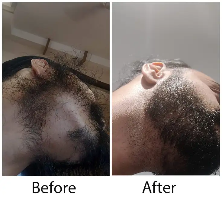 Beard Hair Transplant in Delhi