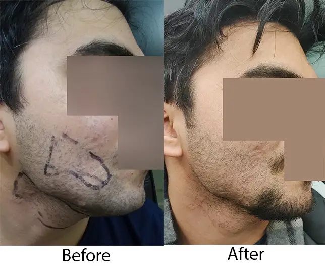 Beard Hair Transplant in Delhi