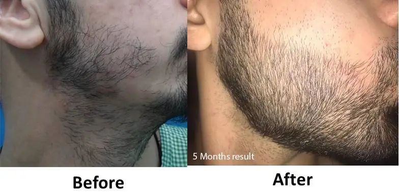 Beard Hair Transplant in Delhi