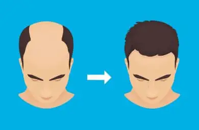 best hair transplant doctor in delhi