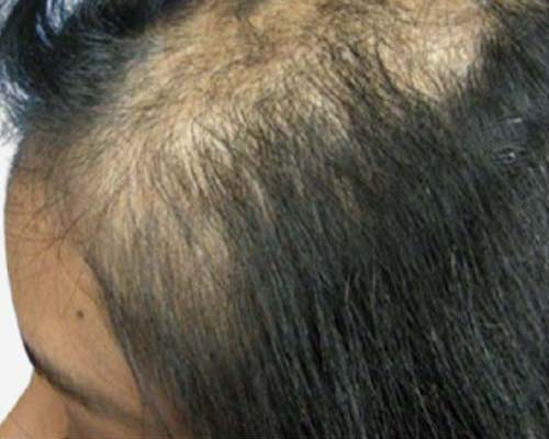 Hair Transplant for Women