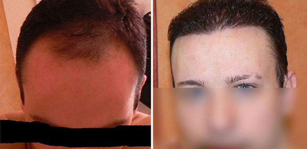 This Europe based Caucasian male underwent 4210 FUSE/fue grafts to acheive a non balding youthful hairline.