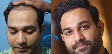 hair transplant in Delhi