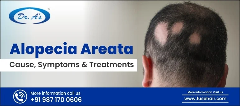 alopecia areata causes symptoms treatments