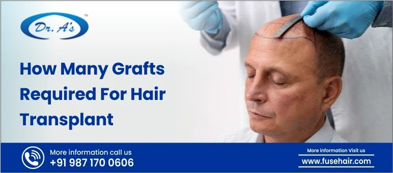 grafts required for hair transplant