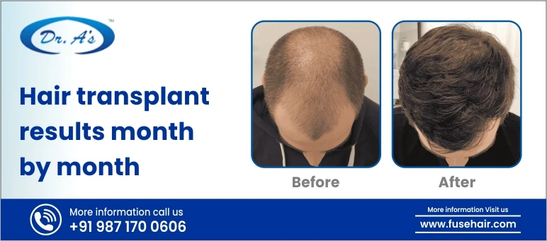 hair transplant results month by month