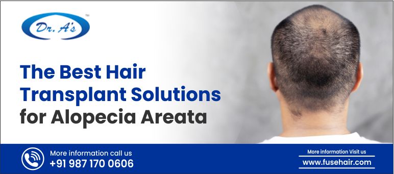 the best hair transplant solutions for alopecia areata