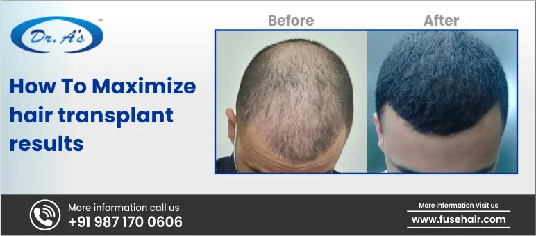 How To Maximize Hair Transplant Results?