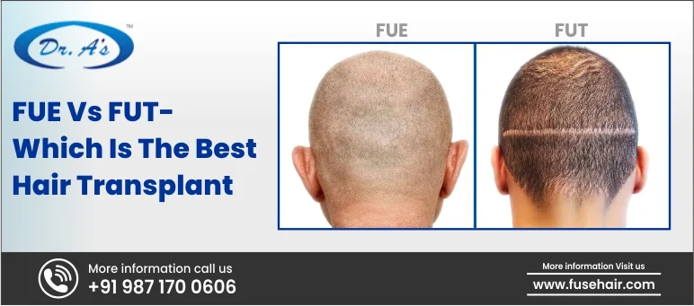 FUE Vs FUT - Which Is the Best Hair Transplant?