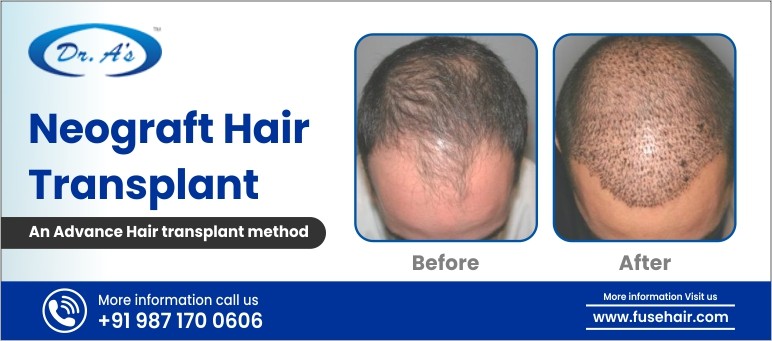 Neograft hair transplant