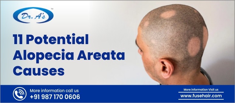 11 potential alopecia areata causes