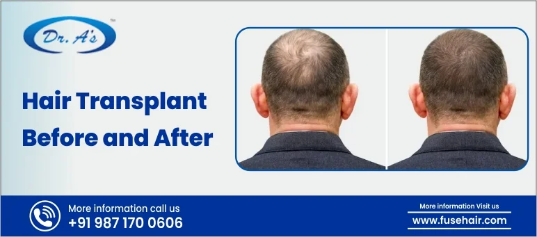 hair transplant before and after