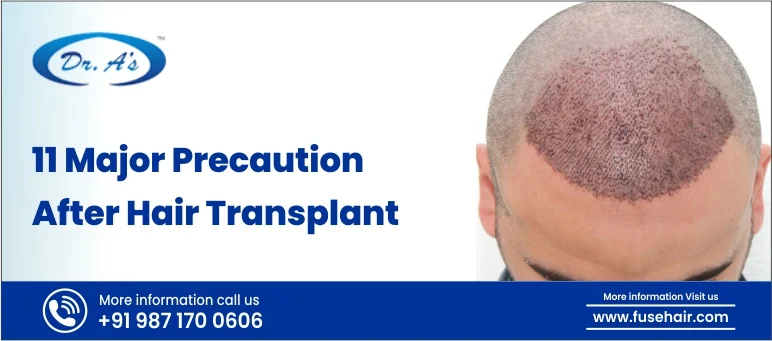 11 Major Precautions After Hair Transplant