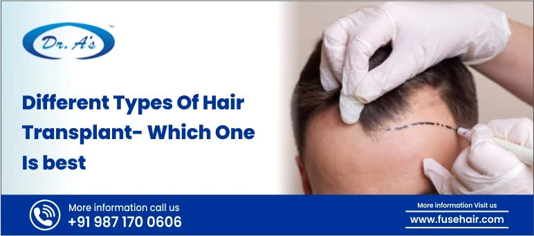 Different Types Of Hair Transplant- Which One Is Best