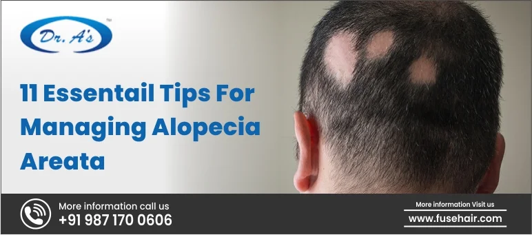 Essential Tips For Managing Alopecia Areata