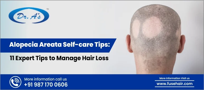 Alopecia Areata Self-care Tips
