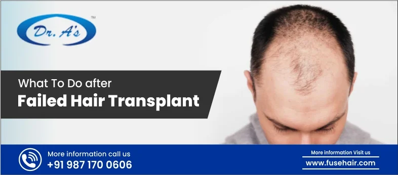 What To do after a failed Hair Transplant