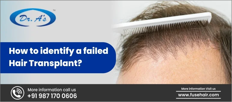 How to identify a failed hair transplant