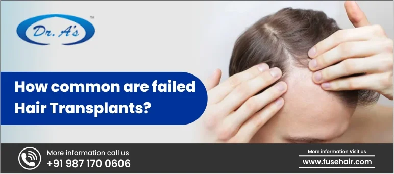 How common are failed hair transplants