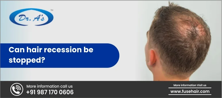 Can Hair Recession Be Stopped?