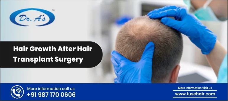Hair Growth After Hair Transplant Surgery