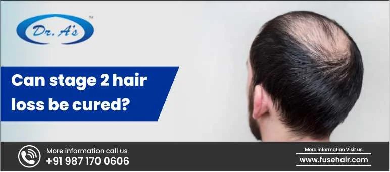 Can Stage 2 Hair Loss Be Cured?