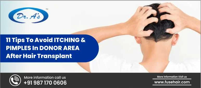 11 Tips To Avoid ITCHING & PIMPLES In DONOR AREA After Hair Transplant