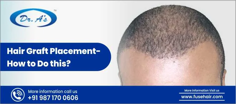 Hair Graft Placement- How to Do This