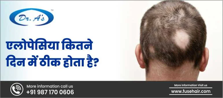 एलोपेसिया को ठीक होने में कितने दिन लगते हैं?