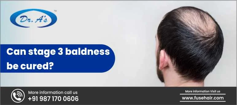 Can stage 3 baldness be cured?