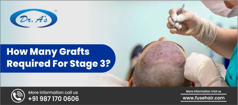 How Many Grafts Are Needed for Stage 3 Baldness?