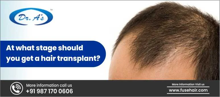 At What Stage Should You Get A Hair Transplant?