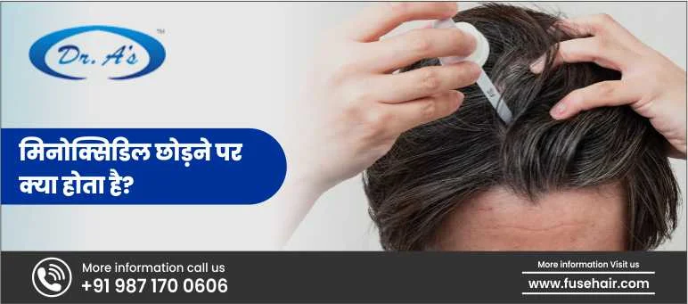 मिनोक्सिडिल छोड़ने पर क्या होता है?