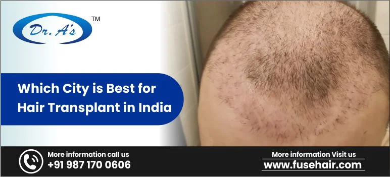 Which City Is The Best For Hair Transplant In India?