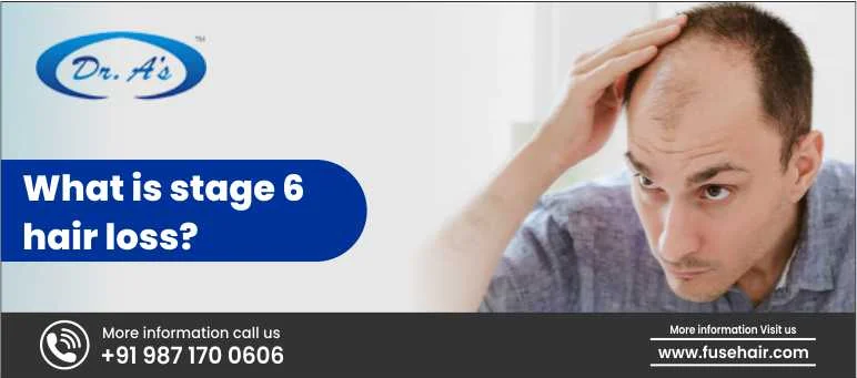 What Is Stage 6 Hair Loss?