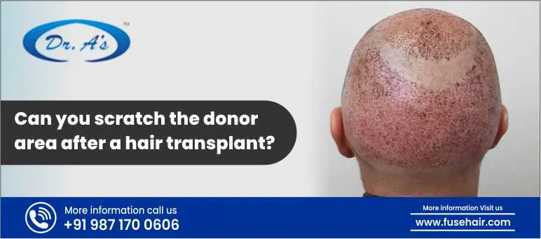 Can You Scratch The Donor Area After A Hair Transplant?