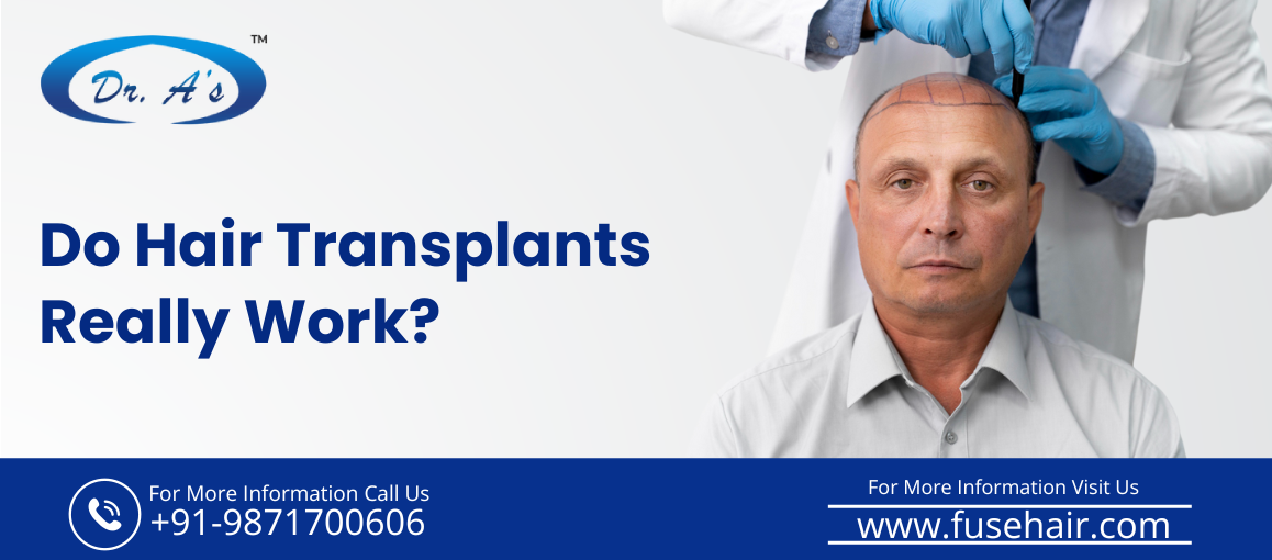 hair transplant surgery in india